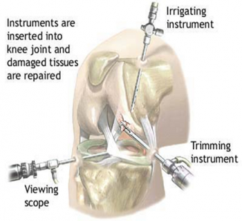 KneeArthroscopy-pic1-350x320